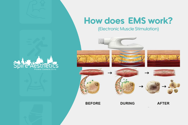 EMS treatment for post pregnancy weight loss treatment Frimley