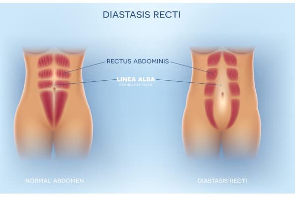 What Non-Surgical Options Are Available for Diastasis Recti Frimley?