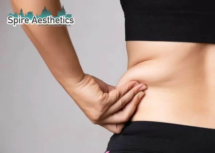 Image of woman pinching fat on their hips Frimley. Fat Freezing treatment