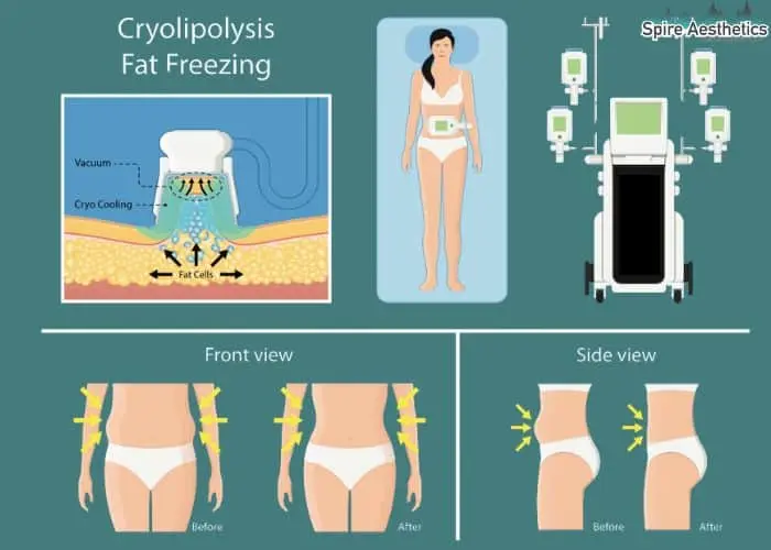 Fat freezing treatment Frimley benefits for competitions to remove stubborn fat deposits.