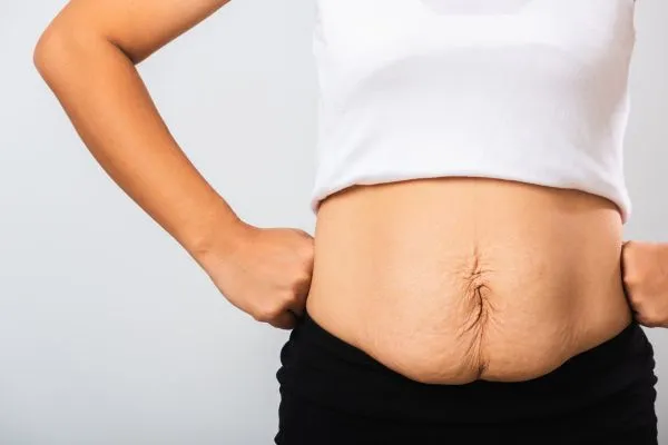 Image of a woman's stomach after weight loss with sagging skin following a gastric band Frimley