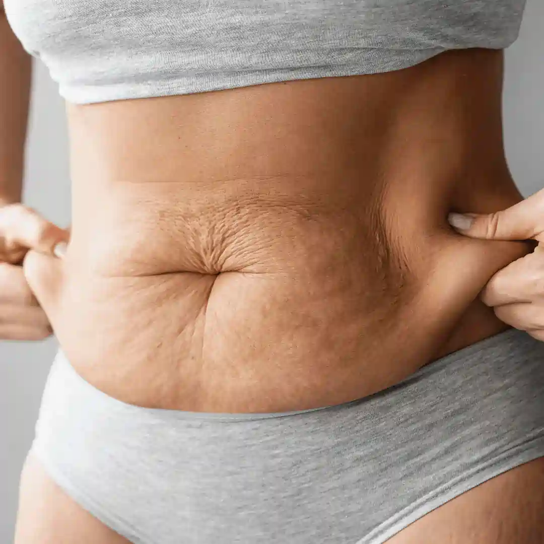 Is It Normal to Have Loose Skin After Pregnancy Frimley?