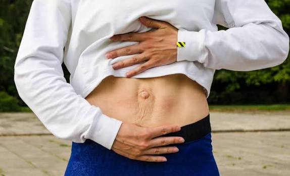 When Could Diastasis Recti Be the Missing Piece of the Puzzle Frimley?