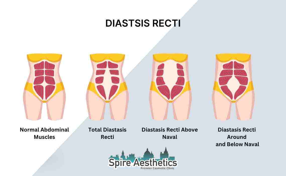 Is Non-Surgical Diastasis Recti Treatment Right for You? Common Concerns Answered Frimley
